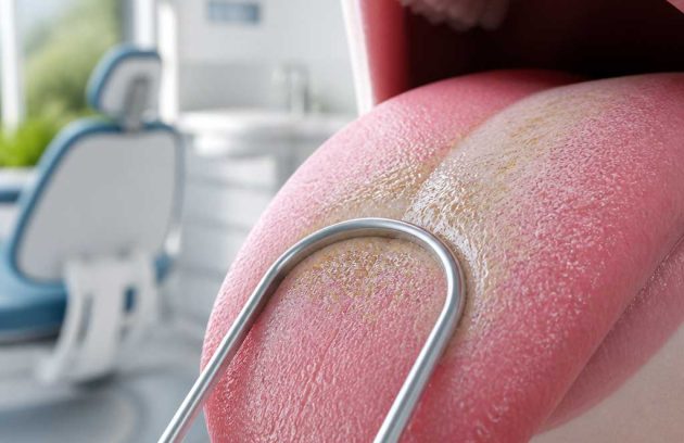 Tongue Cleaning and Bad Breath: What You Should Know 3 Tongue Cleaning