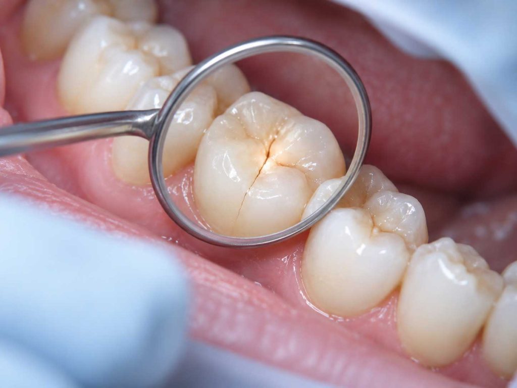 Tooth Hurts When Biting
